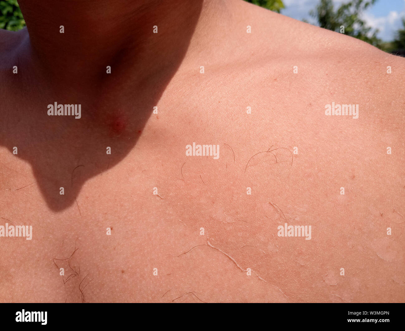 Les effets du coup de soleil sur la peau. Monter la peau. Banque D'Images