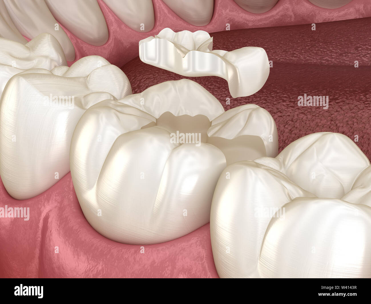 La fixation de la couronne en céramique encastré à plus de dent. Illustration 3D précis sur le plan médical de traitement des dents humaines Banque D'Images