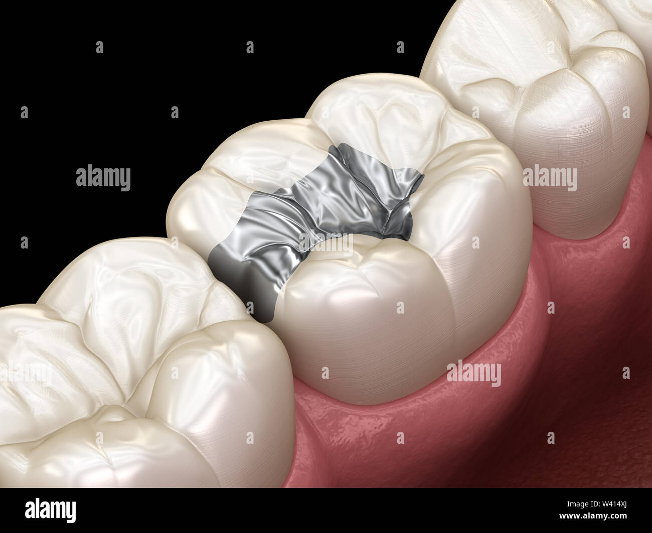 La fixation de la couronne d'argent Inlay sur dent. Illustration 3D précis sur le plan médical de traitement des dents humaines Banque D'Images