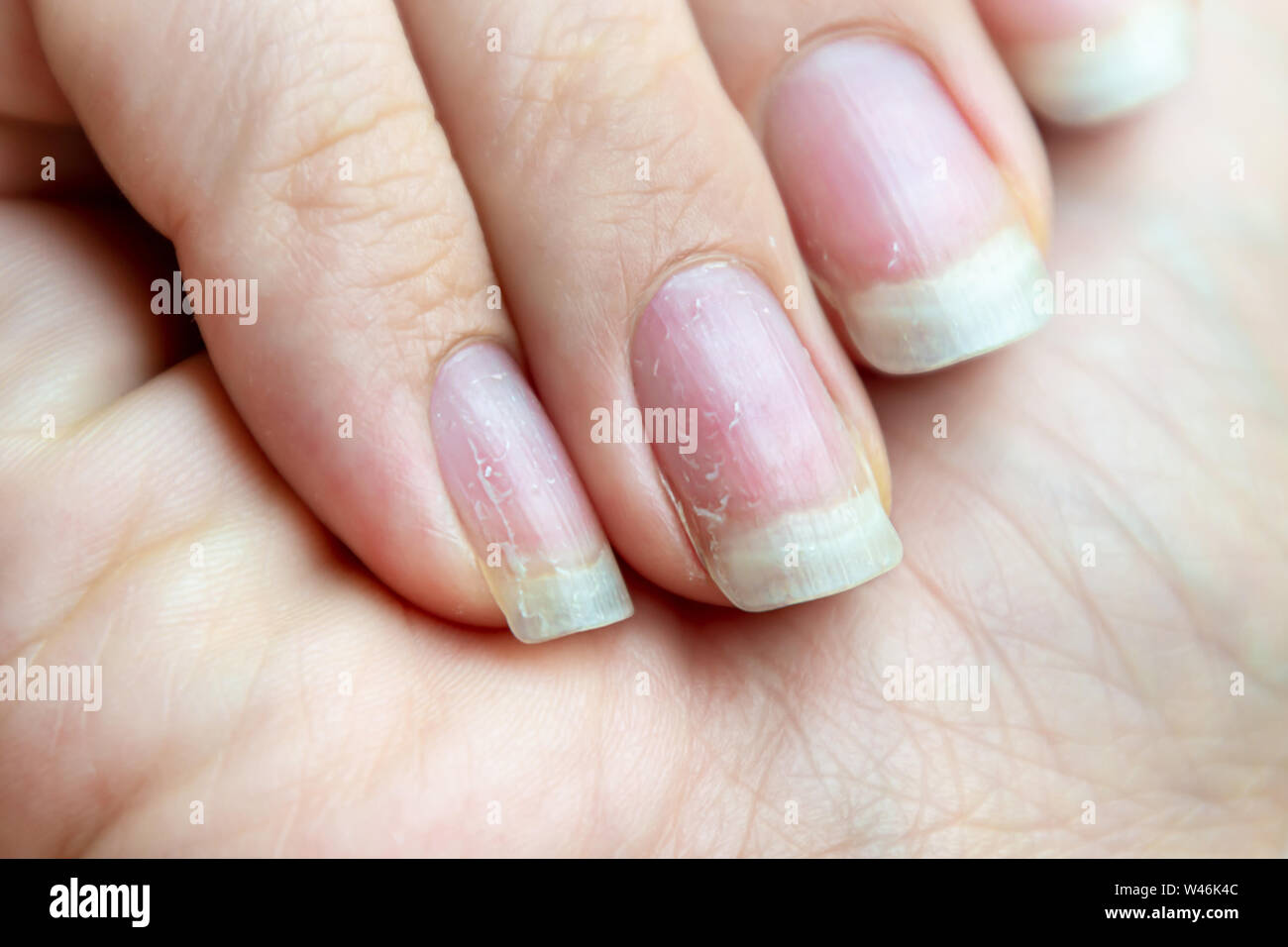 Les ongles endommagés qui ont problème après avoir fait la manucure. Problème de santé et de beauté. Banque D'Images