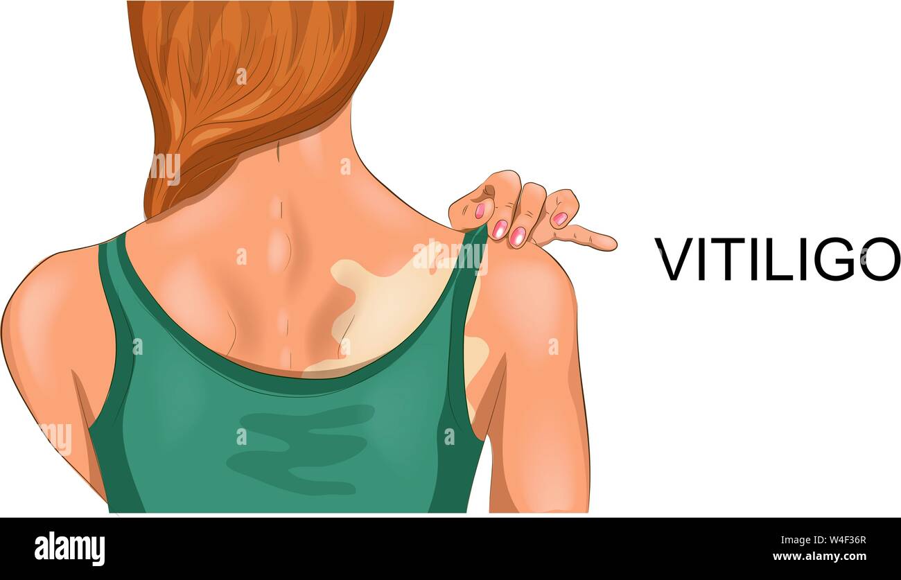 Vector illustration de vitiligo sur femelle Illustration de Vecteur