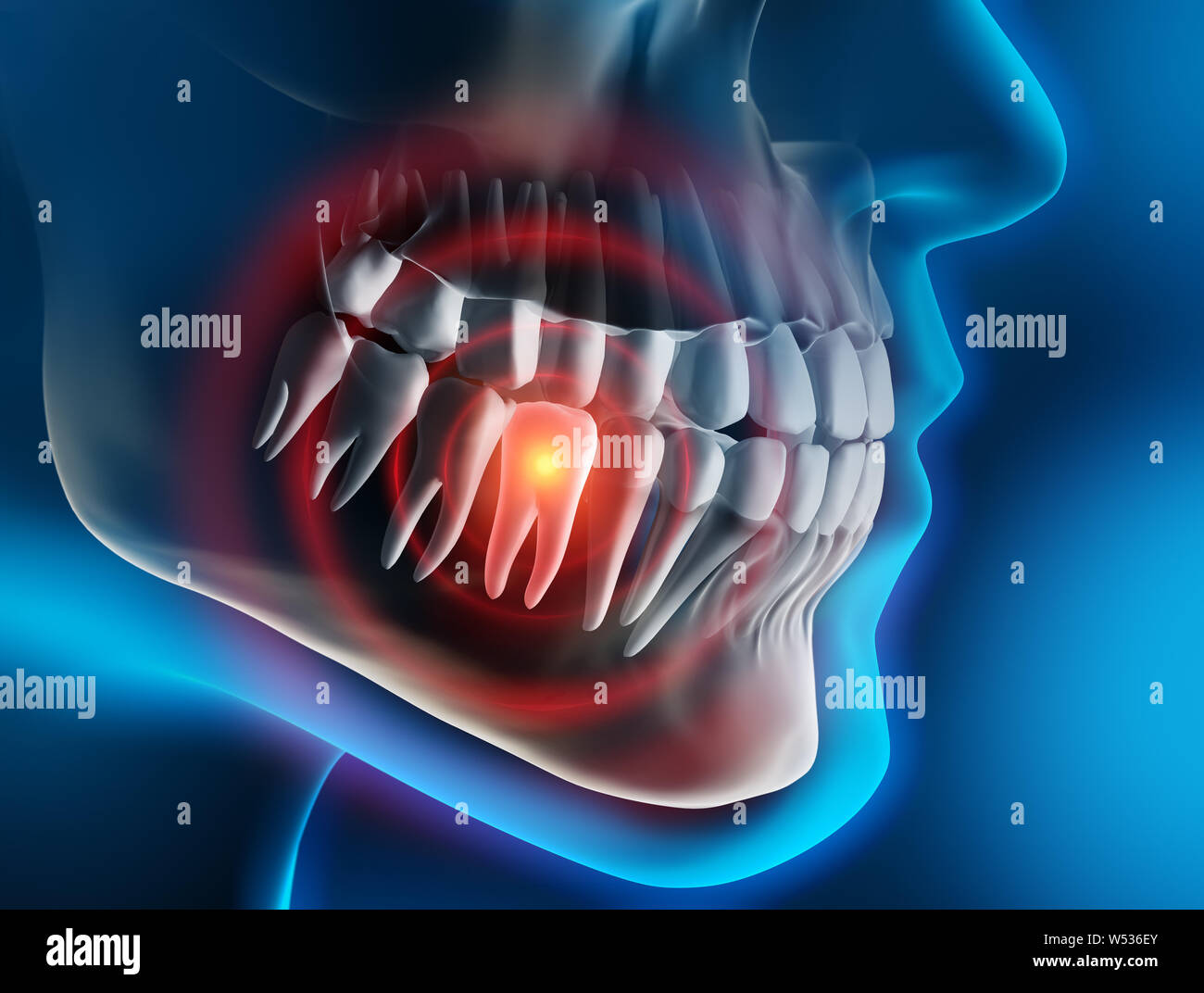 La douleur dentaire lourd - 3D illustration Banque D'Images