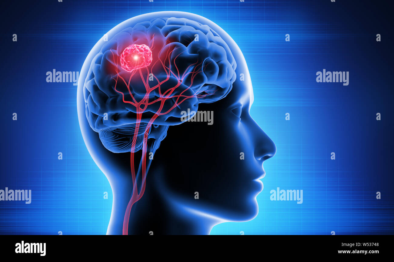 Avec tête et cerveau - tumeur 3d illustration Banque D'Images