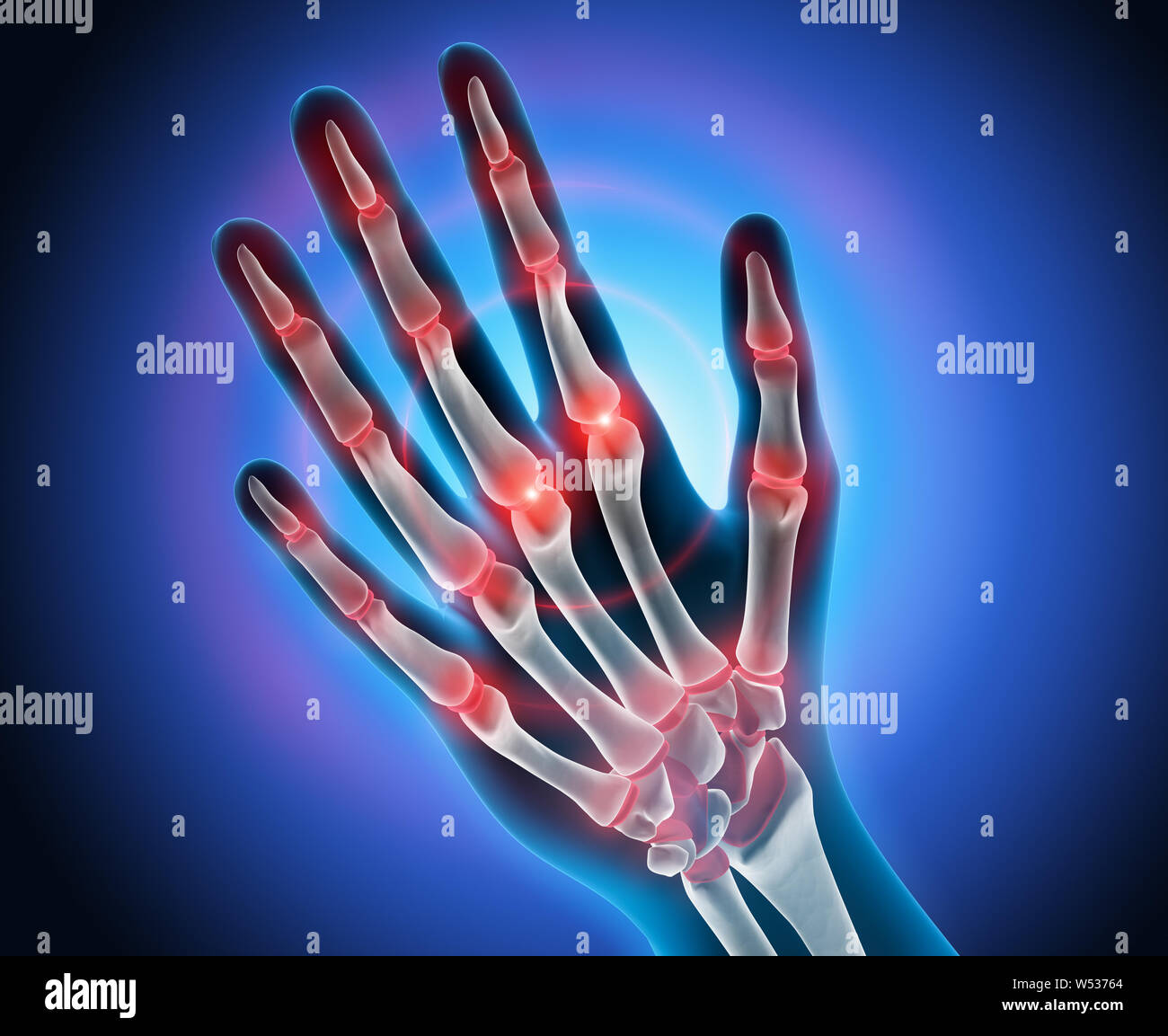 La main avec la douleur dans les articulations - Arthrite - Illustration 3d Banque D'Images