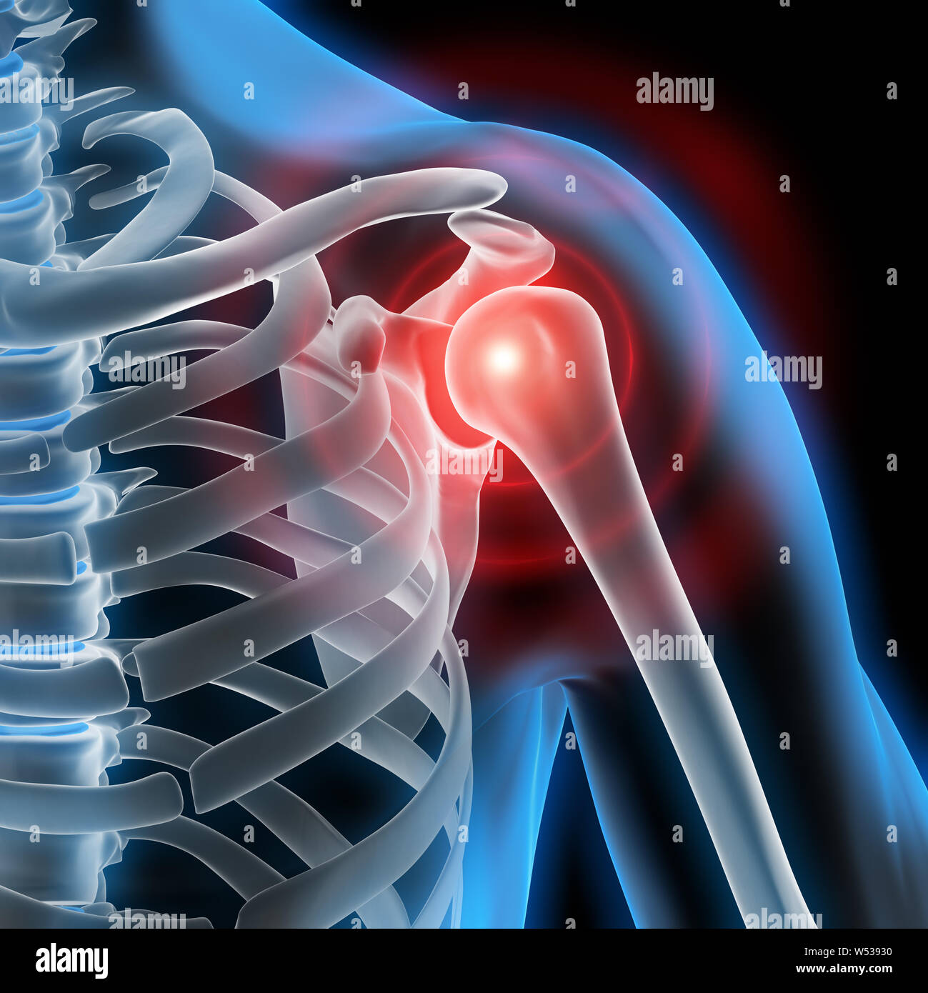 La douleur de l'épaule - Illustration médicale 3D Banque D'Images