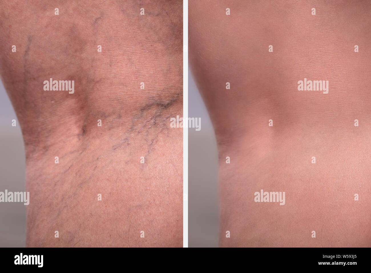 Une personne du genou avec des varices et des capillaires avant et après traitement médical Banque D'Images
