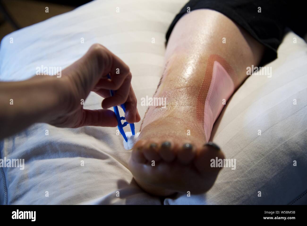 La stérilisation d'une plaie chirurgicale avant l'enlèvement des agrafes  d'une femme après une intervention chirurgicale pour réparer une fracture  de la cheville Photo Stock - Alamy