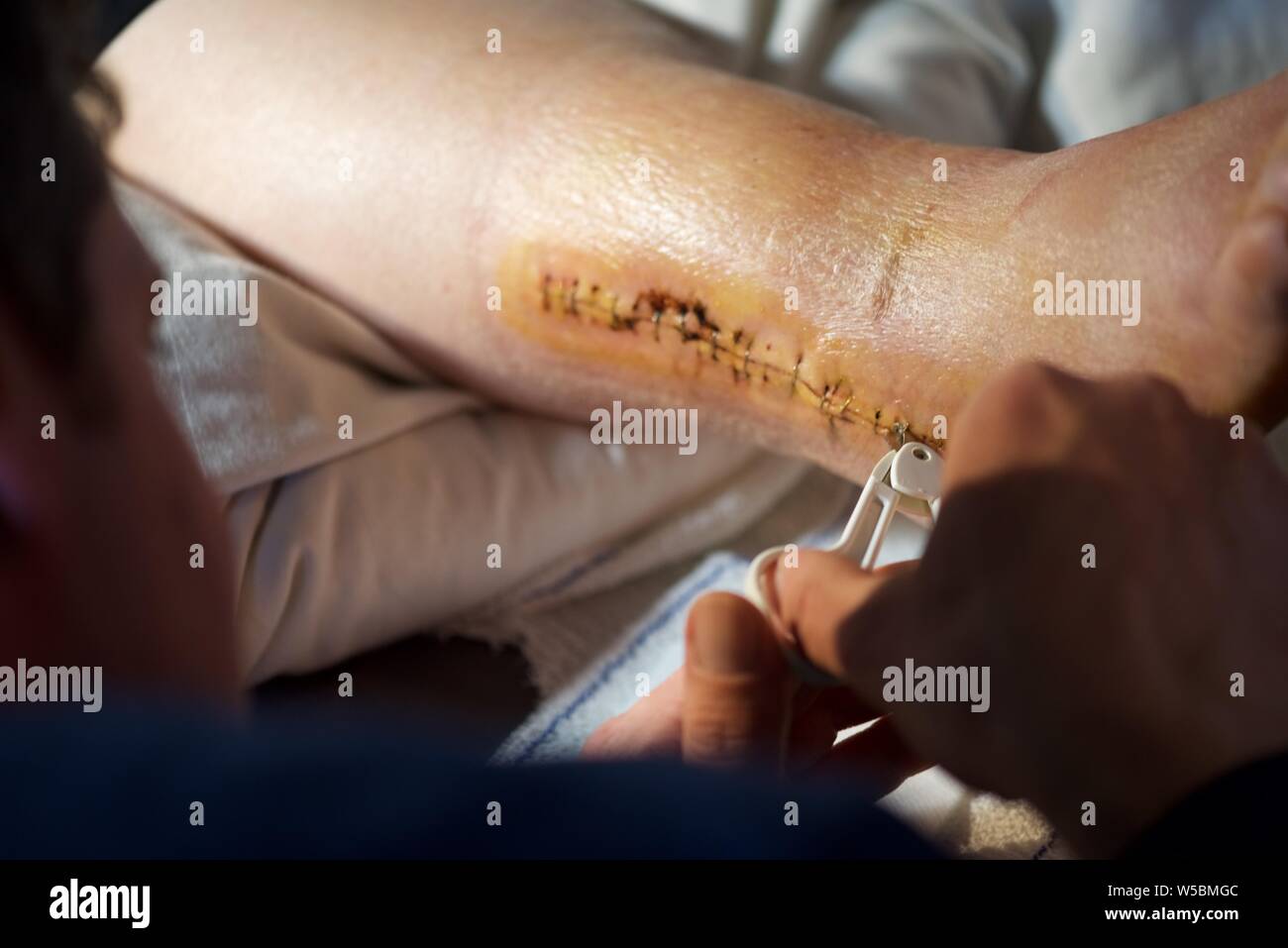 Agrafes chirurgicales : suppression des agrafes chirurgicales de la cheville droite d'une femme après une intervention chirurgicale pour réparer une fracture de la cheville Banque D'Images