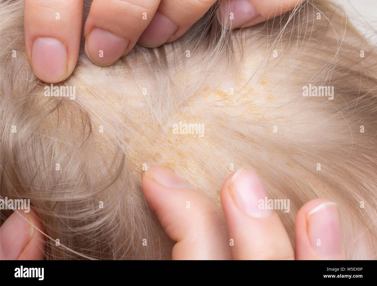 Éruption de peau séborrhéique sur l