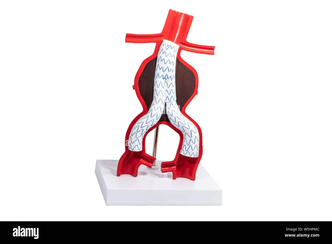 Le traitement endovasculaire des anévrismes de modèle avec endoprothèse fenêtrée et ramifiées-greffes. Banque D'Images