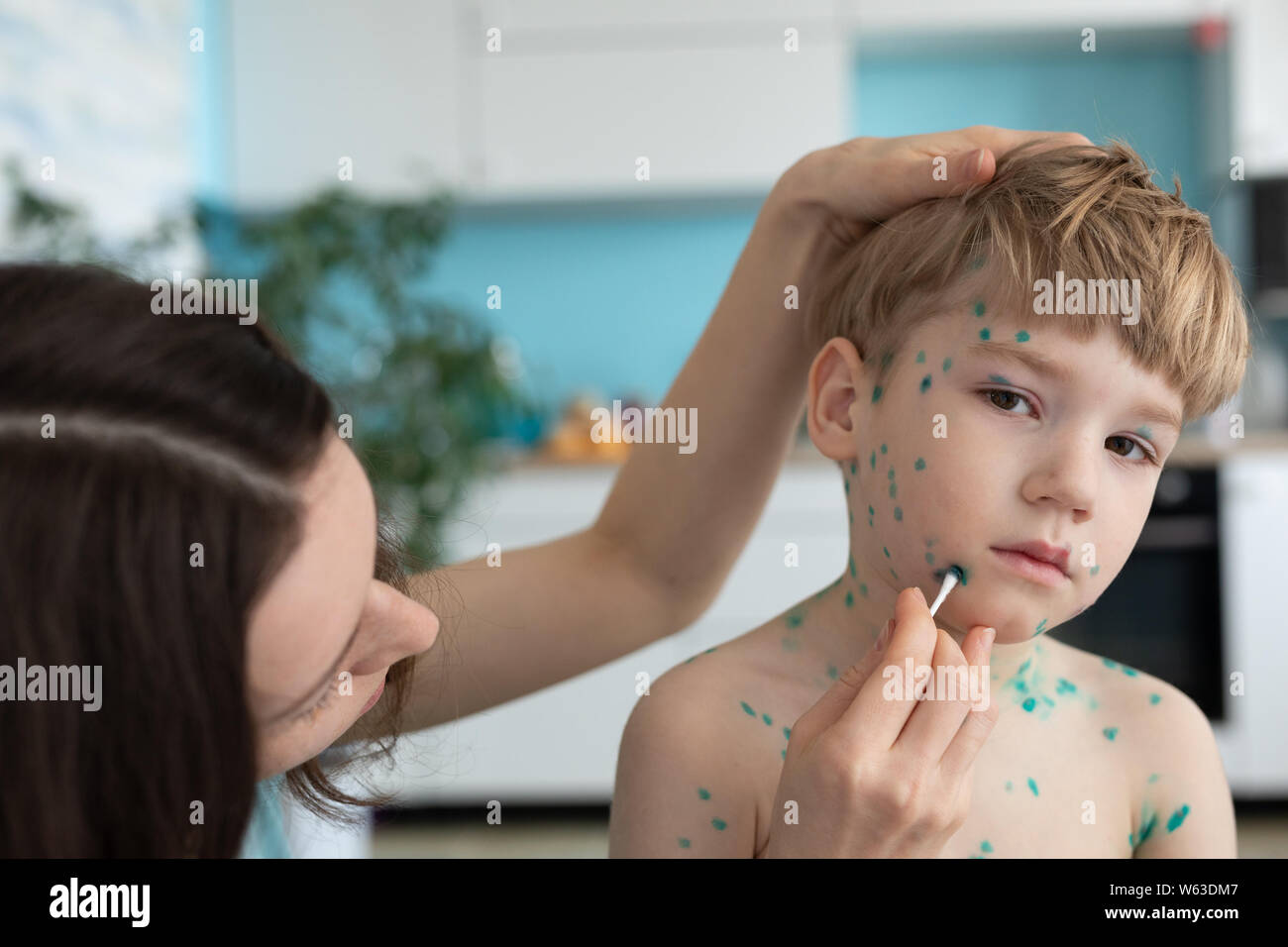 Maman traite son fils, traite les imperfections et les boursouflures sur son visage. Banque D'Images Maman traite son fils, traite les imperfections et les boursouflures sur son visage. Banque D'Images