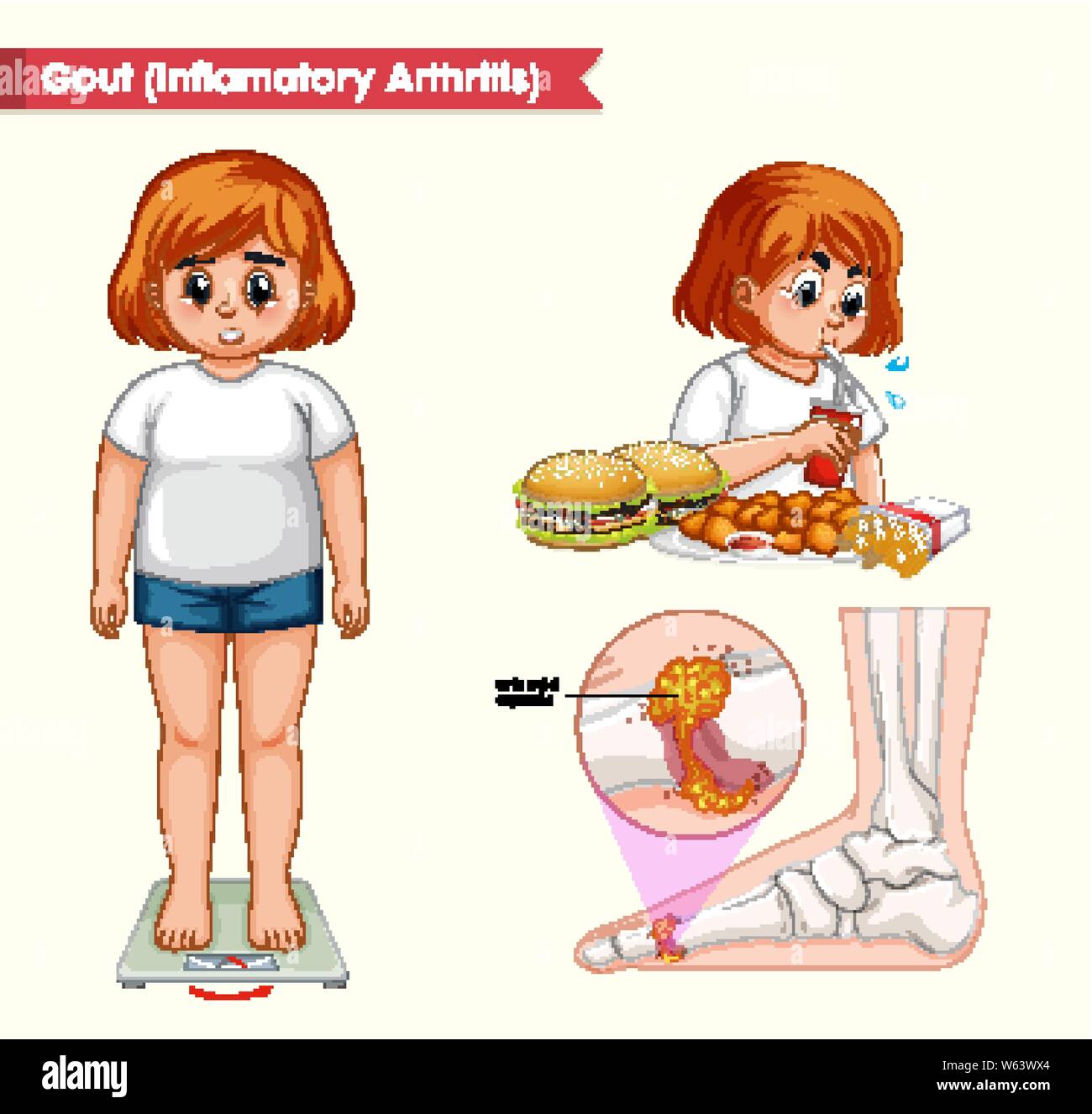 Illustration médicale scientifique de la goutte arthrite illustration Illustration de Vecteur