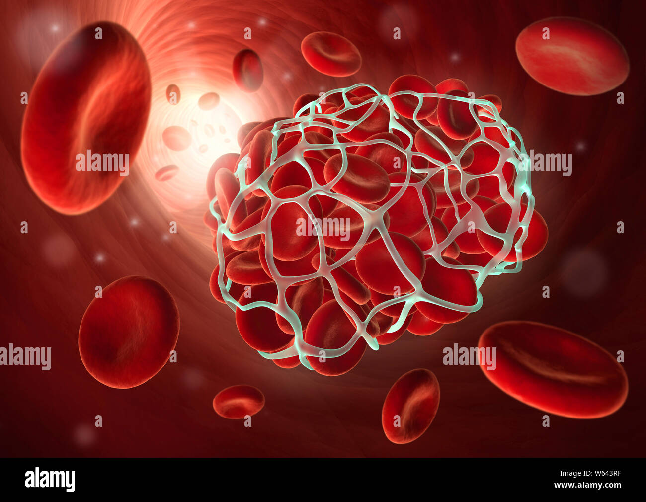 Illustration médicale d'un caillot sanguin ou thrombus - coagulation - illustratio 3D Banque D'Images
