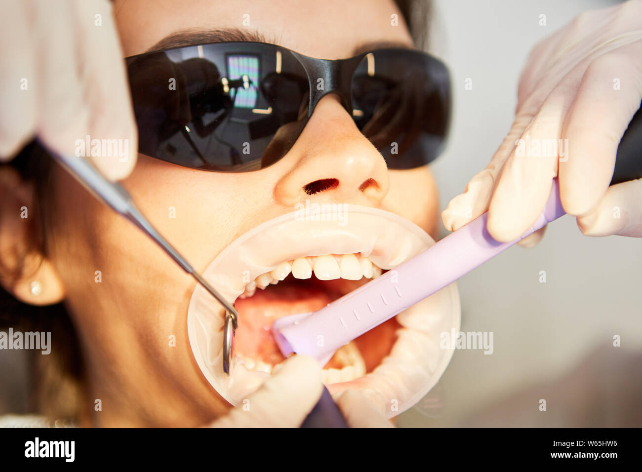 Patient avec une large bouche ouverte pendant un traitement avec la carie dentaire ou le tartre Banque D'Images