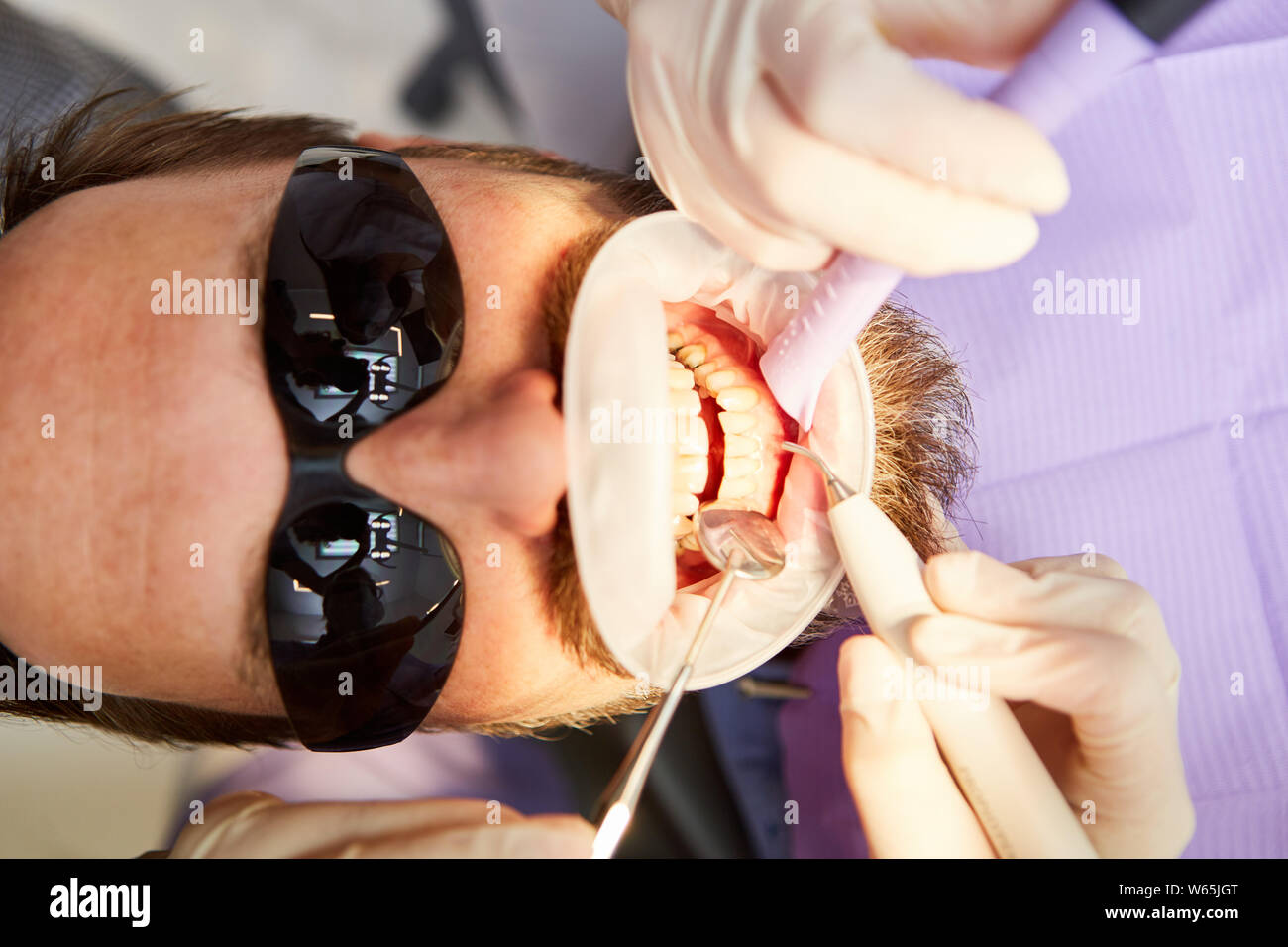 Dentiste enlève le tartre ou la carie dentaire pendant le traitement avec le foret dans le cabinet dentaire Banque D'Images