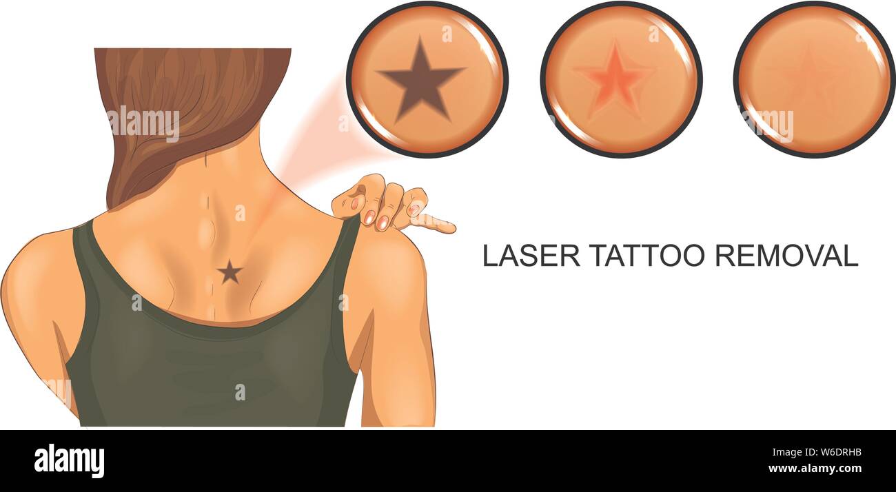 Vector illustration de détatouage au laser à partir de la peau Illustration de Vecteur