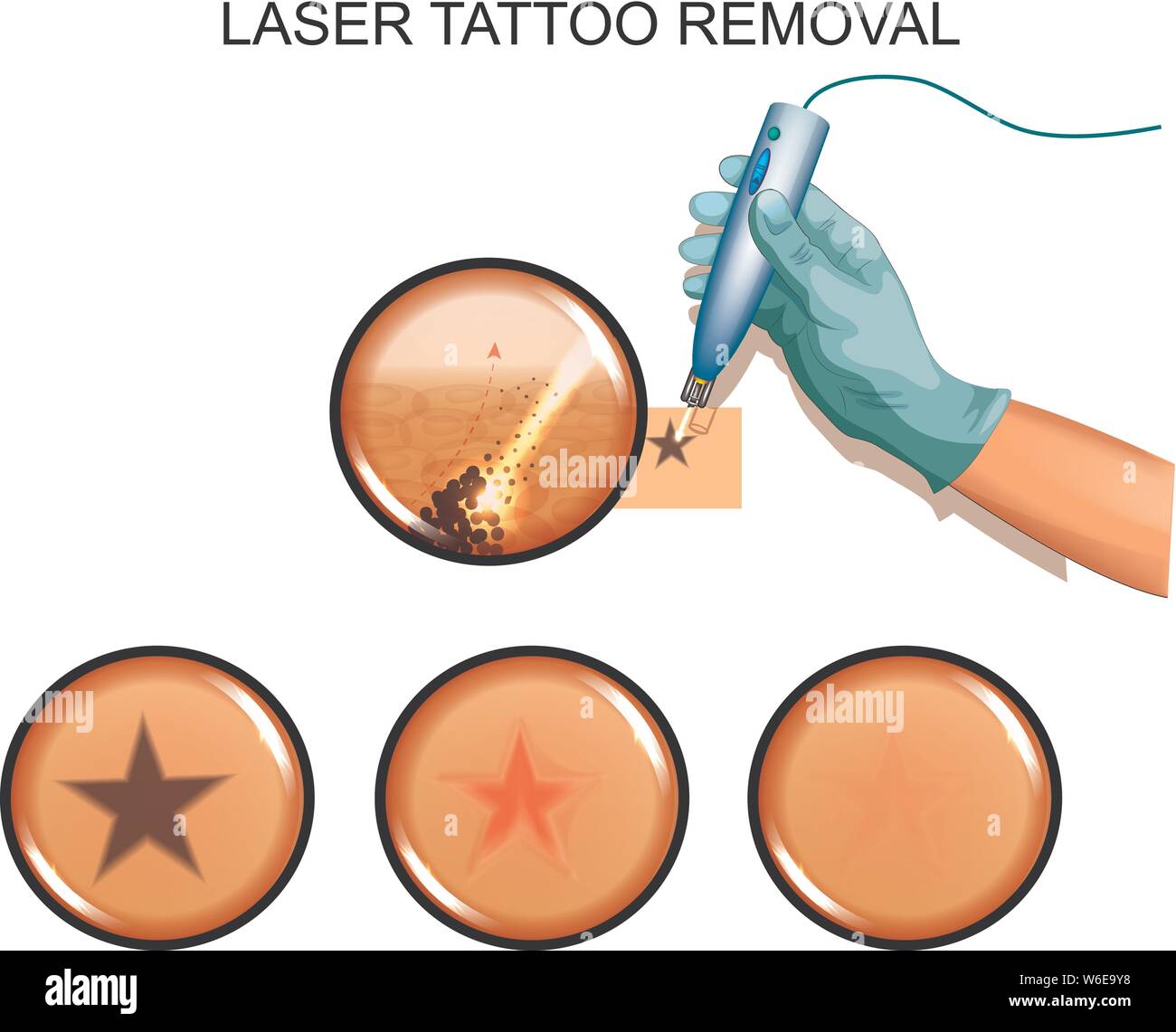 Vector illustration de détatouage au laser à partir de la peau Illustration de Vecteur