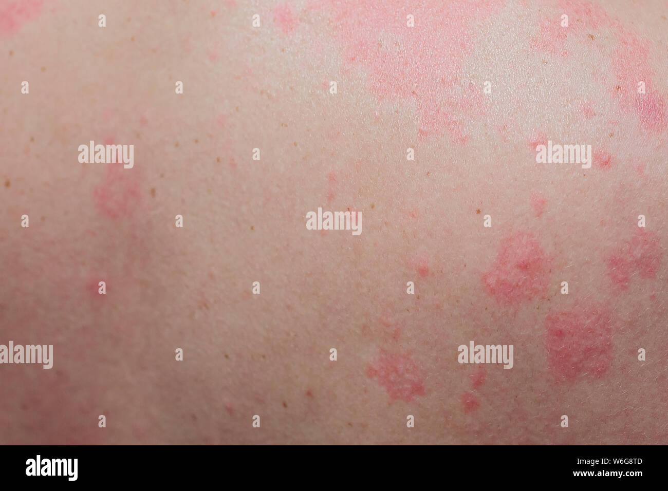 Close up petit fessier, autour de la vue arrière de la dermatite avec