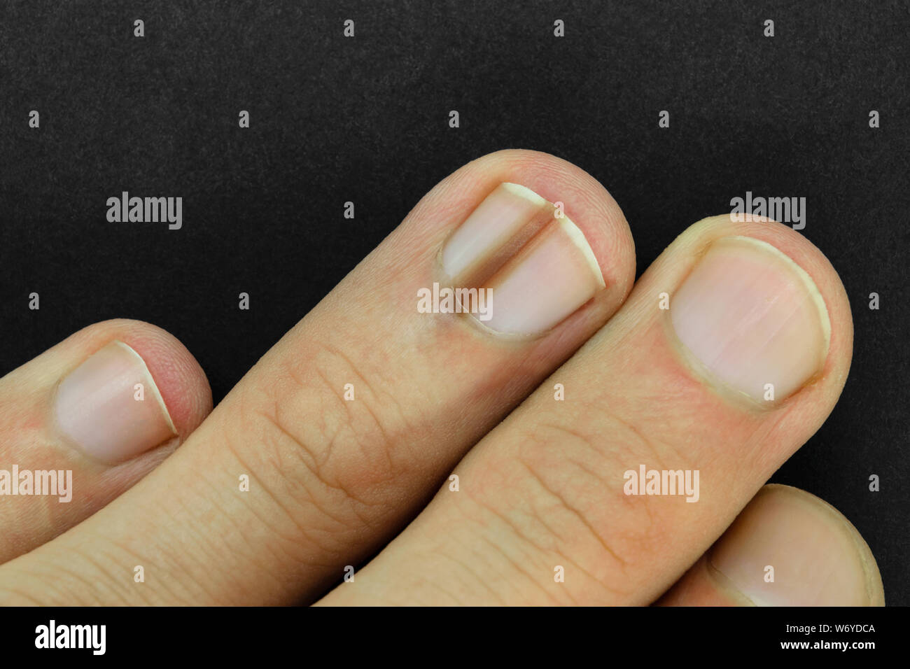 Vue du dessus de l'homme part avec ligne marron sur l'un des ongles de  doigt mieux connu sous le nom de pigmentation des ongles (melanonychia) sur  fond noir et mat surfa Photo