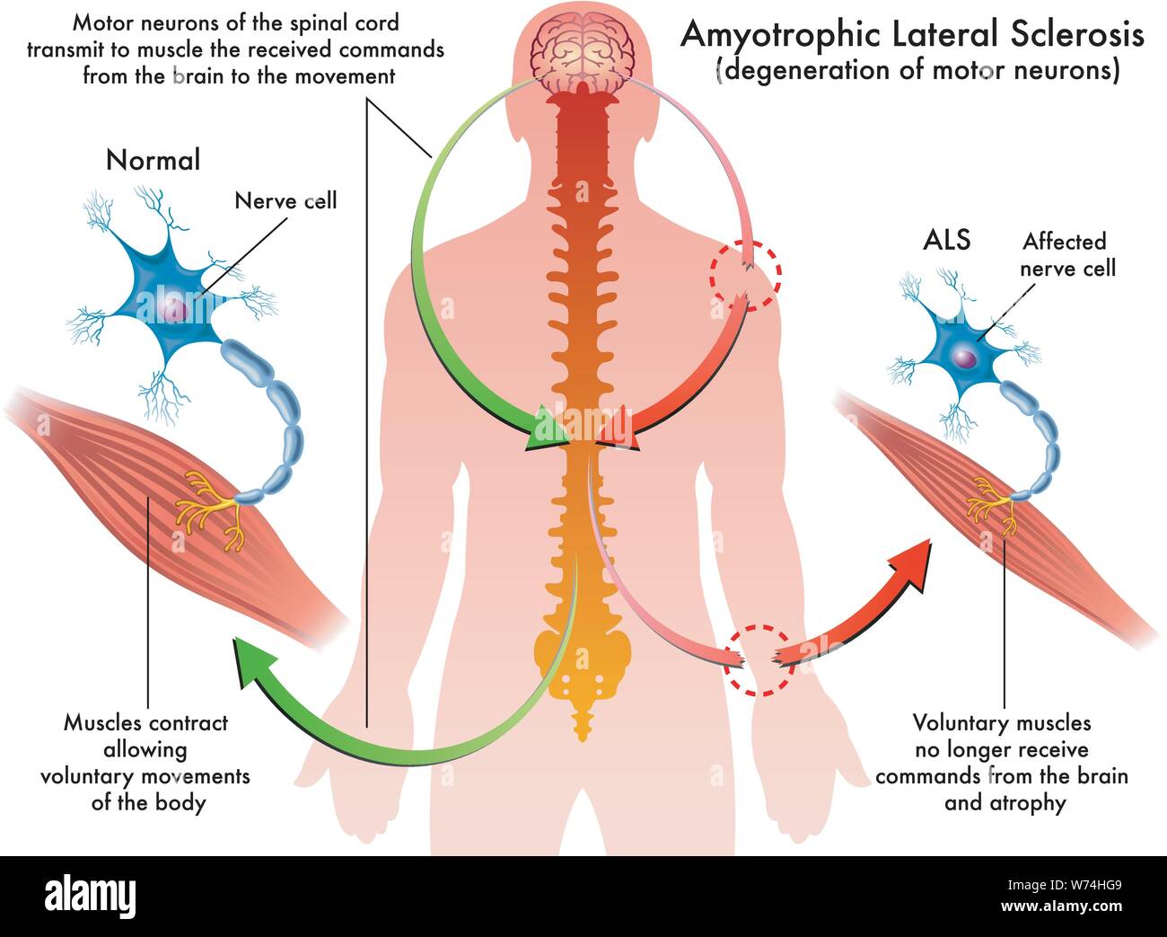 Illustration médicale des symptômes de la SLA (sclérose latérale amyotrophique) Illustration de Vecteur