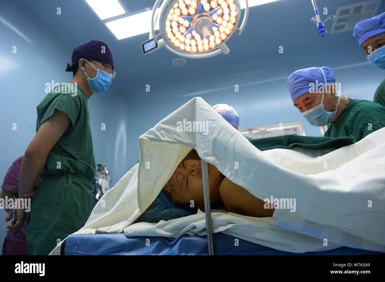 --FILE--21 ans, Xu Qinqin avec son nez arraché par un rat de Zhengjiaba, village du comté de Yuechi, Guang'an city, au sud-ouest du Sichuan en Chine Banque D'Images