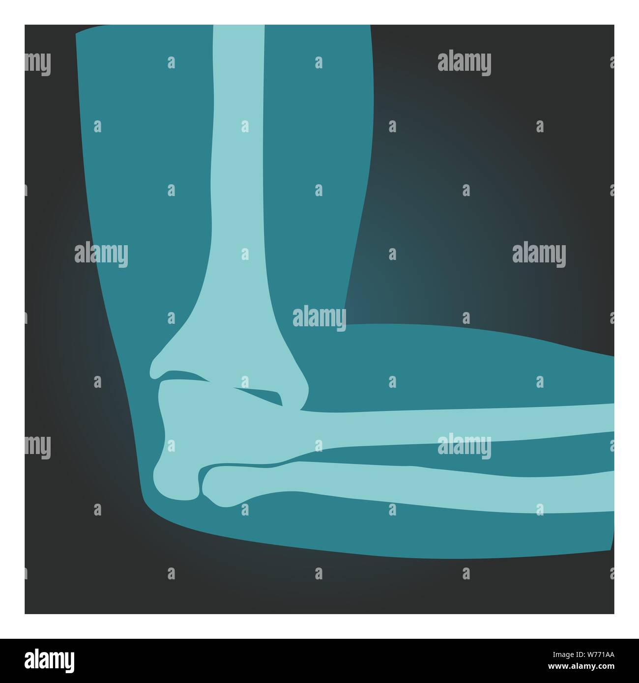 Émission de rayons X d'elbow vue latérale, corps humain, les os de la main, la radiographie, l'illustration vectorielle. Illustration de Vecteur