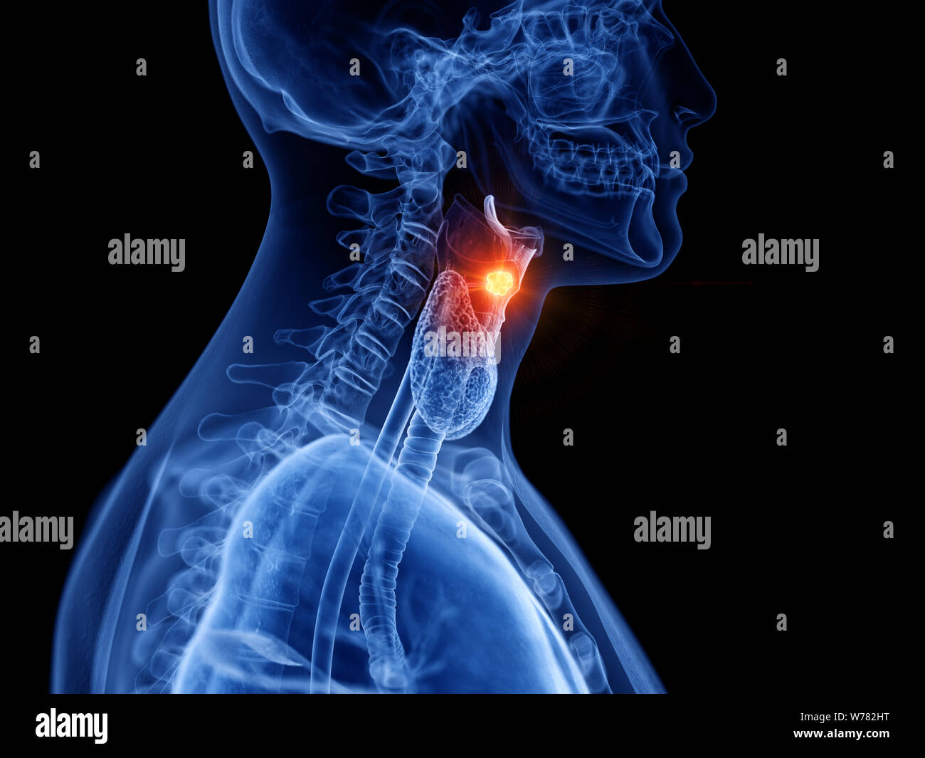 Cancer Des Cordes Vocales Espérance De Vie