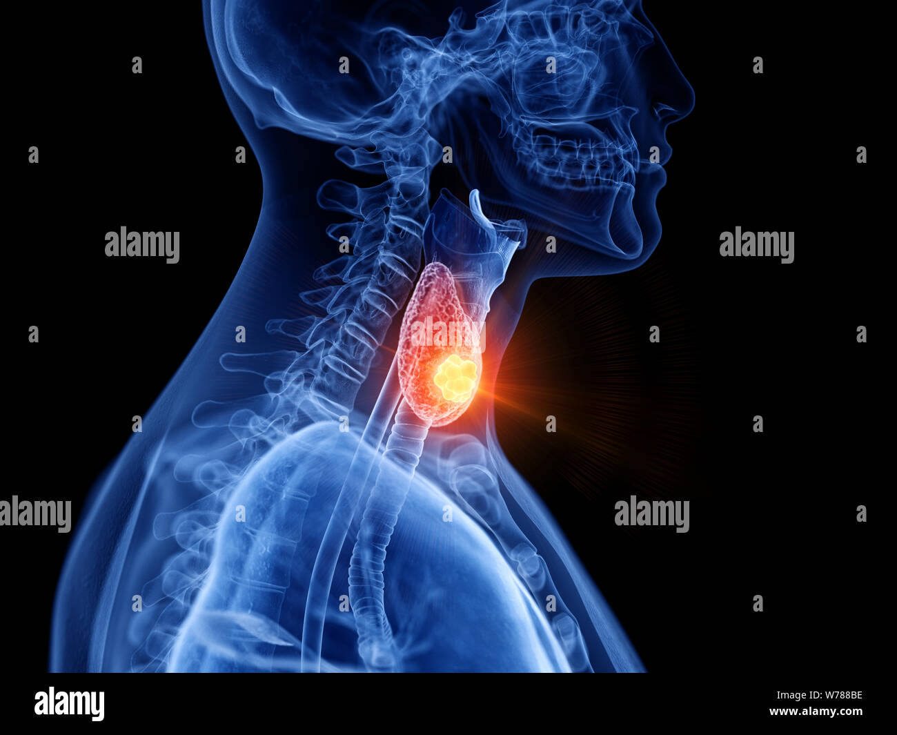 Médicalement en rendu 3d illustration exacte du cancer de la thyroïde Banque D'Images