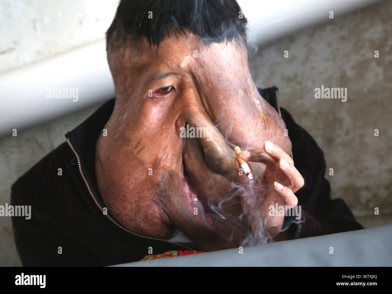'China's Elephant Man' Chuncai Huang, 41 ans, qui souffre d'une tumeur énorme 15kg sur le visage, fume une cigarette à Yulan, village du comté Rudong Banque D'Images