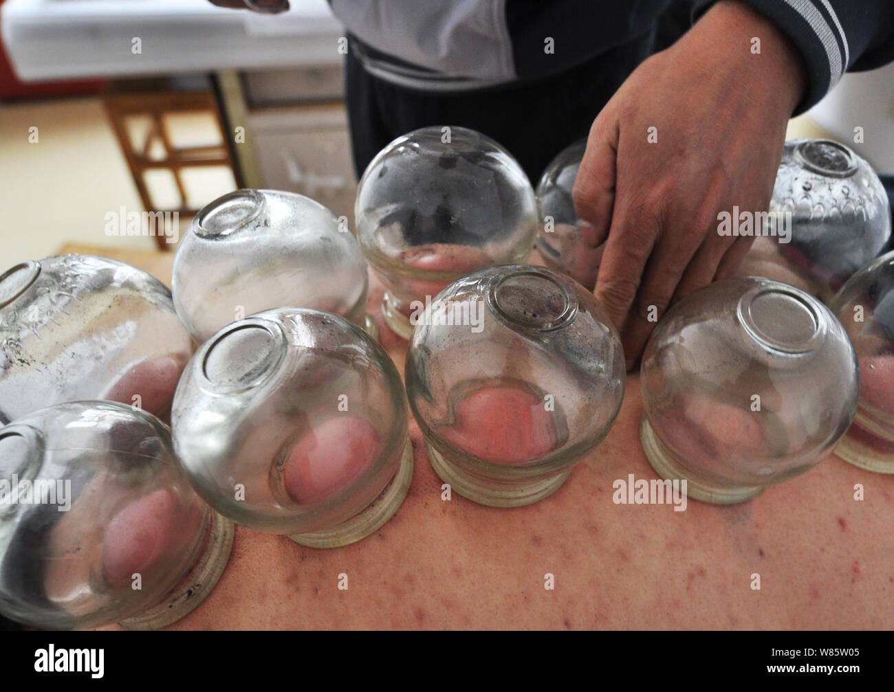 --FILE--un Chinois reçoit cupping therapy de la médecine traditionnelle chinoise (TCM) hôpital de Zouping county, est de la Chine, la province de Shandong, 1 D Banque D'Images