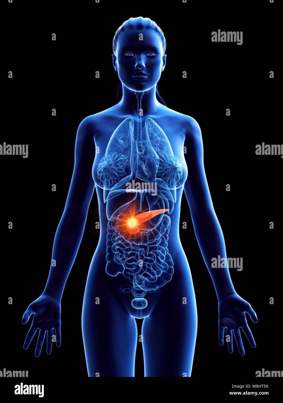 Cancer du pancréas, l'illustration de l'ordinateur conceptuel. Banque D'Images