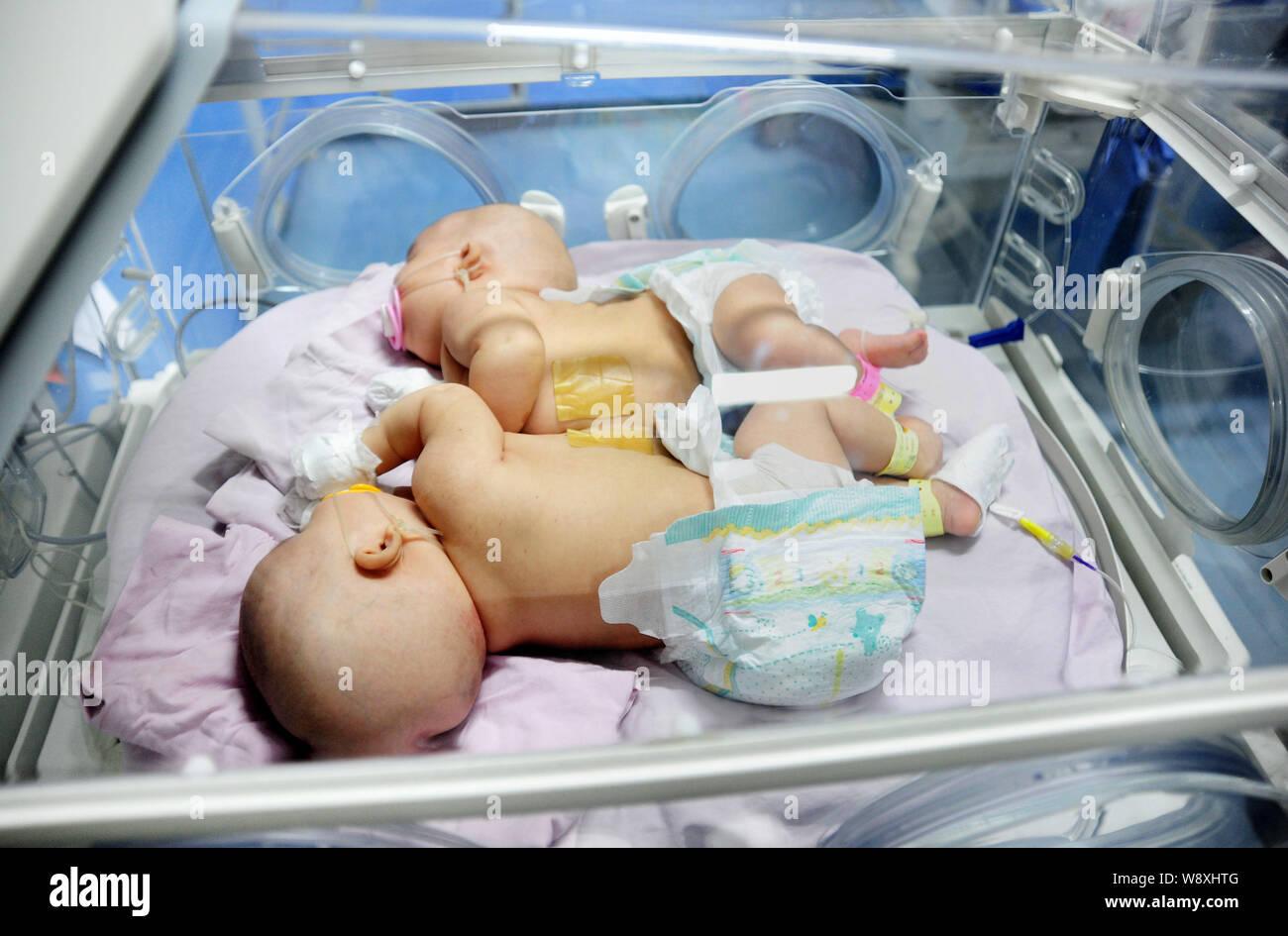 Les deux sœurs jumelles de conjoined résident dans un incubateur avant l'opération pour les séparer à l'Hôpital pour enfants de la province de Jiangxi à Nanchang city, ea Banque D'Images