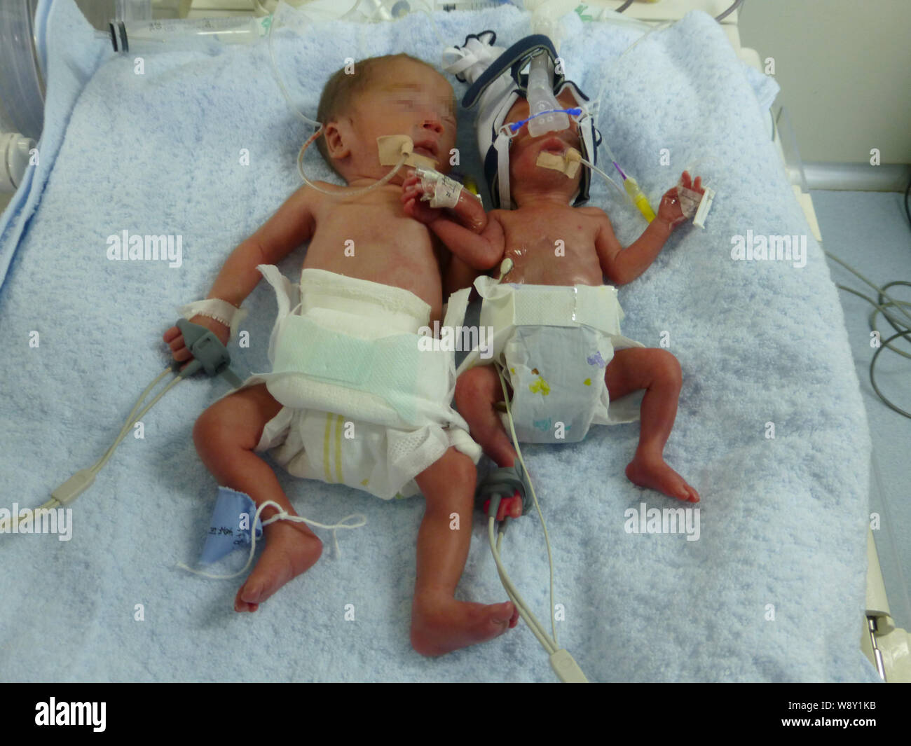 Le 650g bébé nouveau-né et son frère jumeau de 1,100g recevoir un traitement médical dans l'ICU (Intensive Care Unit) à l'Chongqing Centre pour femmes et santé Banque D'Images