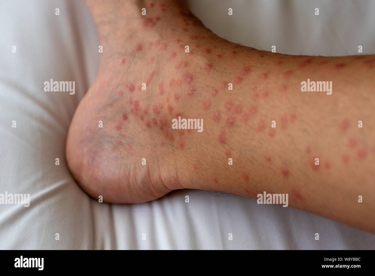 Close up de rougeurs, démangeaisons et l'enflure après de nombreux moustiques piquent sur la jambe - allergie à la salive des moustiques peuvent provoquer de l'urticaire papuleuse ou Skeeter's syndr Banque D'Images
