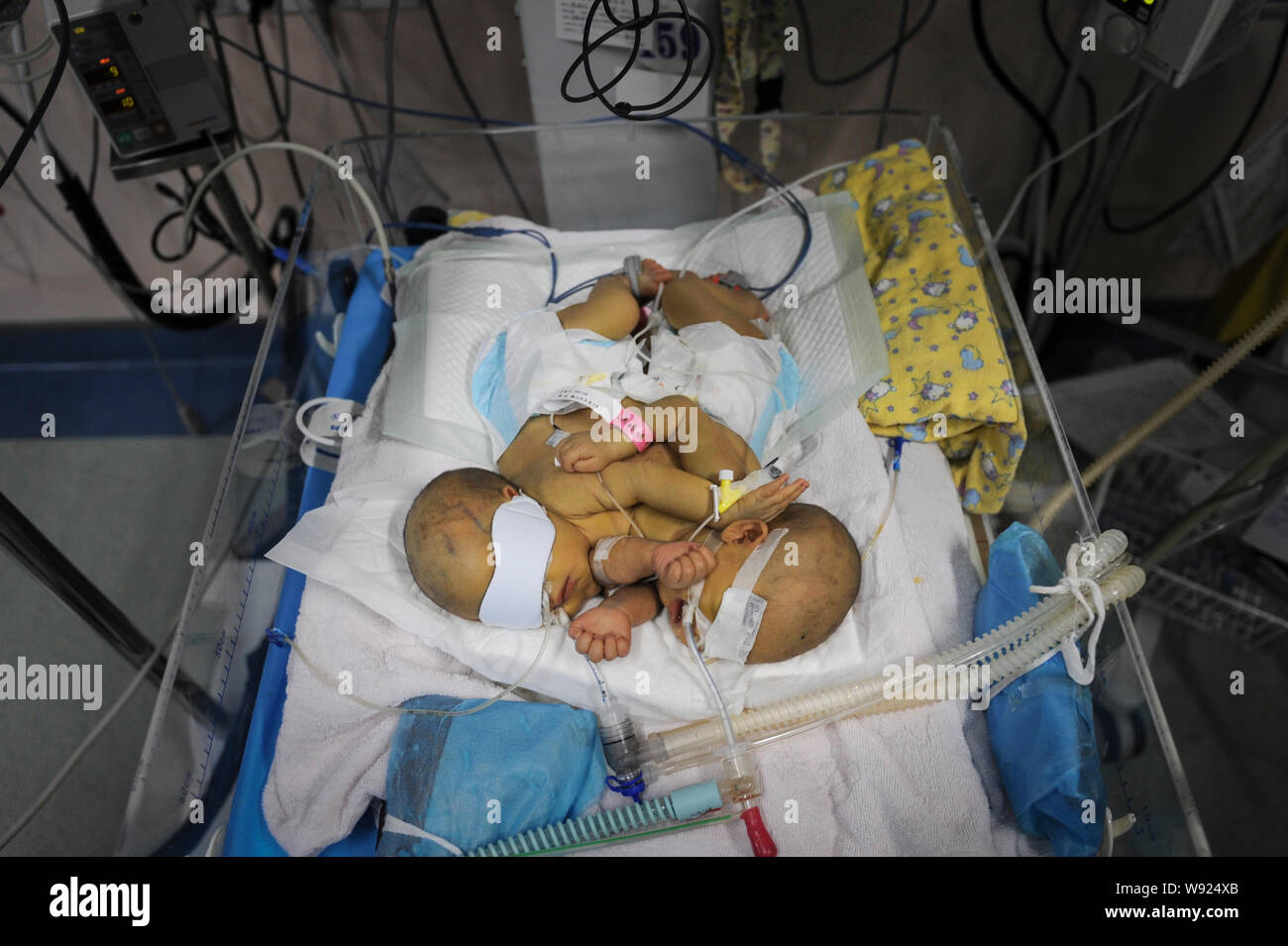 Une paire de jumeaux siamois nouveau-né reçoit un traitement médical en soins intensifs à l'Hôpital pour enfants du Hunan à Changsha city, Hunan province Chines centrale, 5 septembre Banque D'Images