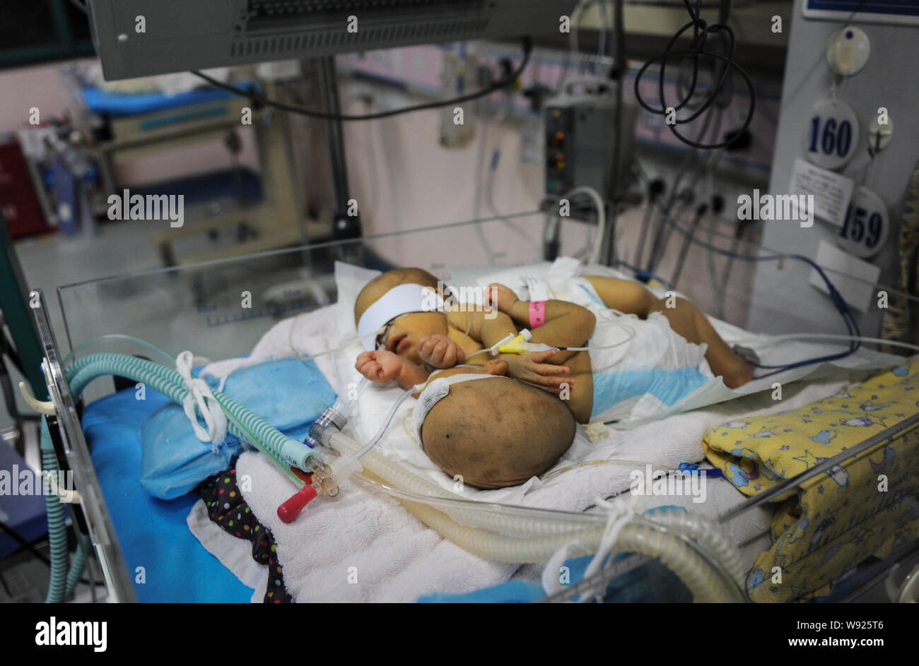 Une paire de jumeaux siamois nouveau-né reçoit un traitement médical en soins intensifs à l'Hôpital pour enfants du Hunan à Changsha city, Hunan province Chines centrale, 5 septembre Banque D'Images