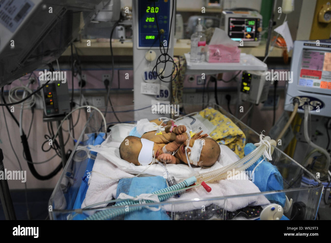 Une paire de jumeaux siamois nouveau-né reçoit un traitement médical en soins intensifs à l'Hôpital pour enfants du Hunan à Changsha city, Hunan province Chines centrale, 5 septembre Banque D'Images