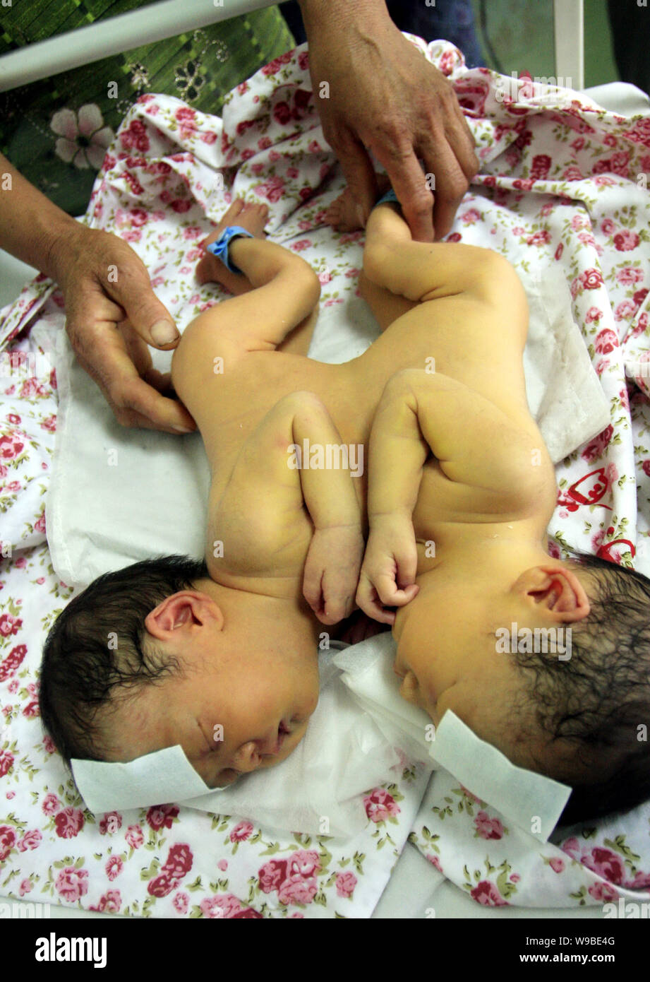 Une paire de jumelles de conjoined nouveau-né sont suivis par leur grand-mère à l'hôpital provincial de Shandong à Jinan City, Shandong Chines est provi Banque D'Images