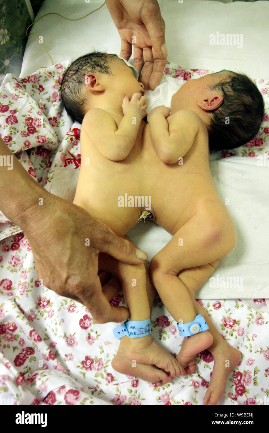 Une paire de jumelles de conjoined nouveau-né sont suivis par leur grand-mère à l'hôpital provincial de Shandong à Jinan City, Shandong Chines est provi Banque D'Images