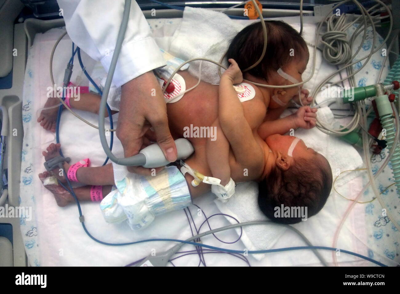 Un médecin examine le nouveau-né des soeurs jumelles siamoises conservés dans un incubateur à l'Hôpital pour enfants de Bayi de Beijing, Chine, le jeudi, 13 août 2009. Banque D'Images