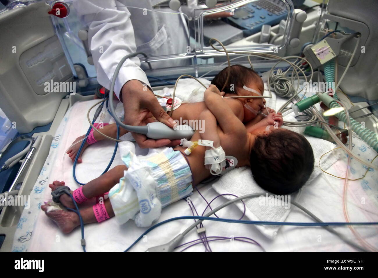 Un médecin examine le nouveau-né des soeurs jumelles siamoises conservés dans un incubateur à l'Hôpital pour enfants de Bayi de Beijing, Chine, le jeudi, 13 août 2009. Banque D'Images