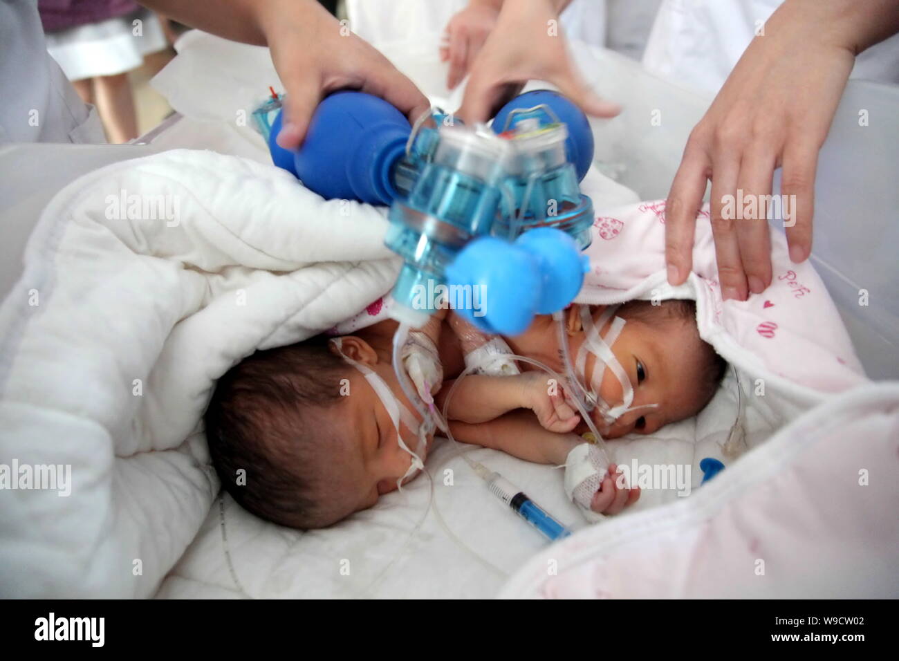 Les infirmières aident le nouveau-né chinois deux sœurs siamoises à respirer à l'Hôpital pour enfants de Bayi de Beijing, Chine, le jeudi, 13 août 2009. La conj Banque D'Images