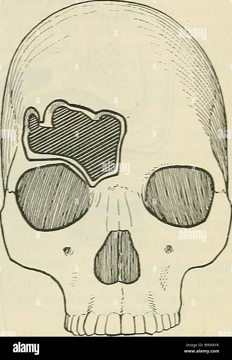 Image d'Archive de la page 1404 de Cunningham's Text-book d'anatomie (1914). Cunningham's Text-book d'anatomie cunninghamstextb00cunn Année : 1914 LE CBAXIOI (. 1371 Fig. 1077. - Droit d'Srsrjs TEBT frontale DIMENSIONS LABGE SESTJS J À GAUCHE (non ouvert). Losran Turner la moitié inférieure de la partie la plus profonde de la paroi postérieure du canal osseux externe et émerge à travers le stylo-Trou mastoïdien (Fig. 1073). Chez le nourrisson, en conséquence de l'absence de l'apophyse mastoïde, la sortie du nerf facial du stylo-Trou mastoïdien n'est pas protégés et exposés sur le latéral plutôt que sur Banque D'Images