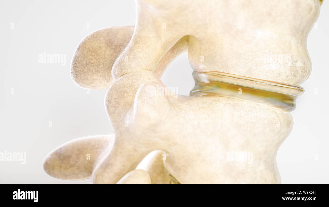 Hernie discale de la colonne vertébrale comme close-up comme le rendu 3D Banque D'Images