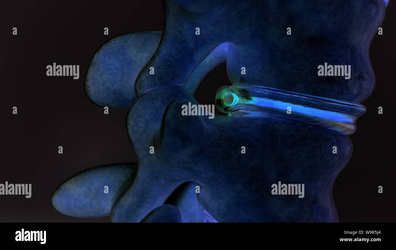 Hernie discale de la colonne vertébrale comme close-up comme le rendu 3D Banque D'Images