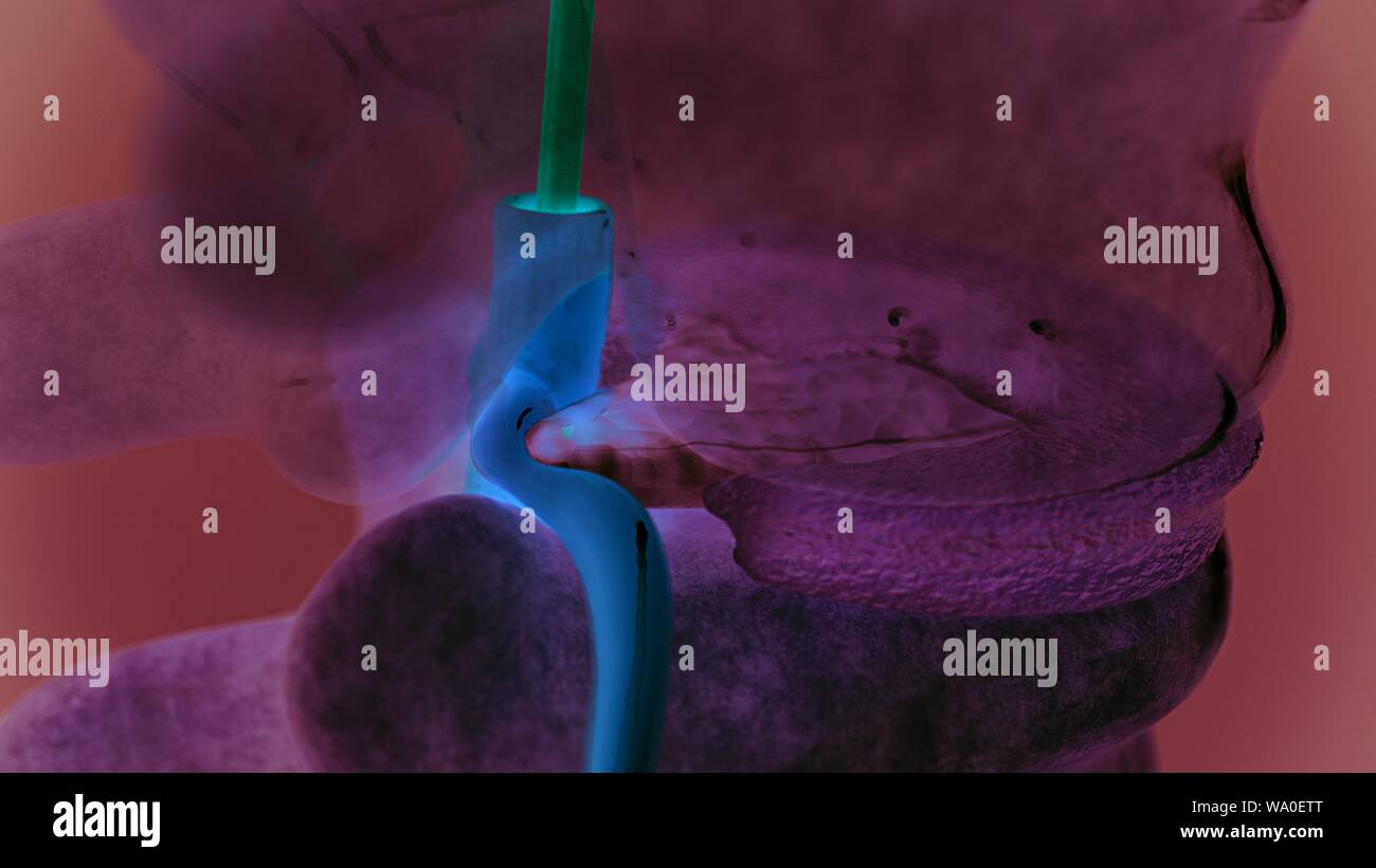Hernie discale de la colonne vertébrale comme close-up comme le rendu 3D Banque D'Images