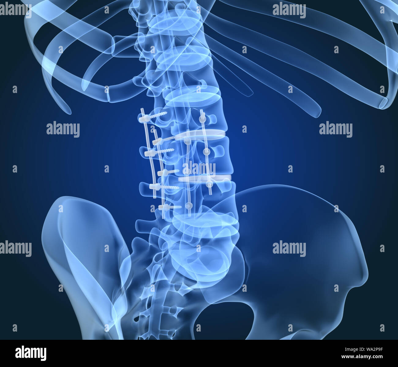 Système de fixation de la colonne vertébrale - titane support. X-ray 3D illustration Banque D'Images