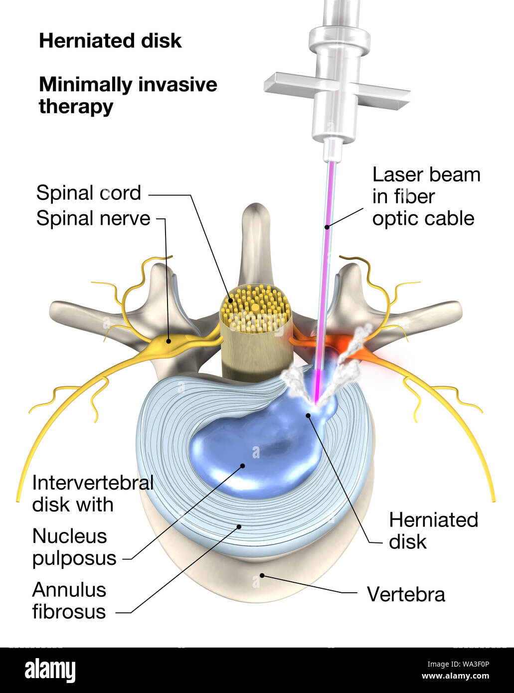Hernie discale douloureuse minimalement invasive, le traitement par  faisceau laser en optique. 3D illustration médicale sur fond blanc.  L'esprit de l'aiguille d'injection Photo Stock - Alamy