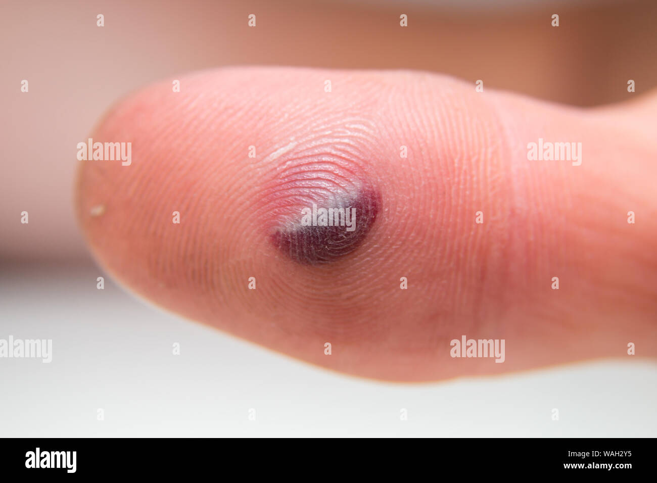 Blister de sang sous la peau du pouce. Portrait jeune homme doigt sur fond blanc Banque D'Images Blister de sang sous la peau du pouce. Portrait jeune homme doigt sur fond blanc Banque D'Images