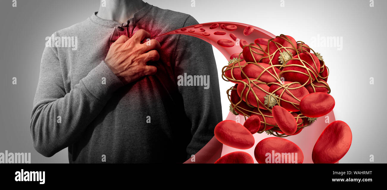 Caillot de sang risque de santé ou thrombose illustration médicale comme symbole d'un groupe de cellules sanguines humaines regroupés ensemble par sticky plaquettes et fibrine comme un Banque D'Images